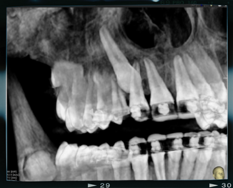 Radiologia digitale tridimensionale xray dentist